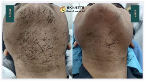 results laser clinic|results laser clinic before.